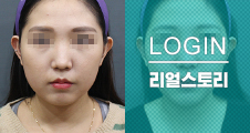 [쁘띠클리닉] 슈퍼윤곽톡스