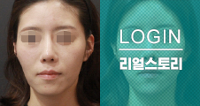 [쁘띠클리닉] 이마,턱,볼,광대